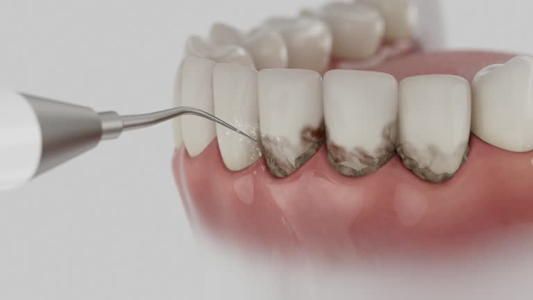 Reliable Dental Implants contractor in Marine, IL by Smile Center Dentistry